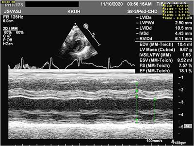 Case Report: Neonatal Multi-System Inflammatory Syndrome Associated With SARS-CoV-2 Exposure in Two Cases From Saudi Arabia